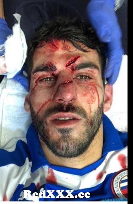 View Full Screen: reading f c striker nelson oliverau2019s facial injuries after an aston villa player accidentally stood on his face.jpg