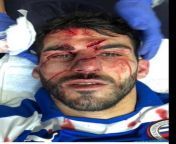 Reading F.C striker Nelson Oliverau2019s facial injuries after an Aston Villa player accidentally stood on his face. from anna cristina de olivera